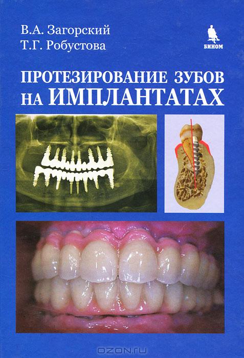 Протезирование зубов на имплантатах